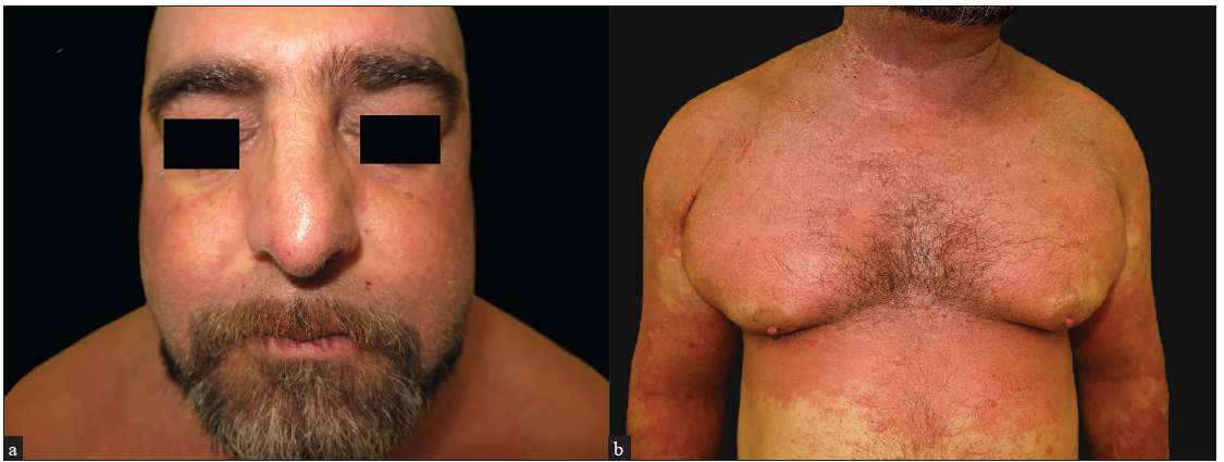 Erythrodermic atopic dermatitis responding to tralokinumab after dupilumab failure